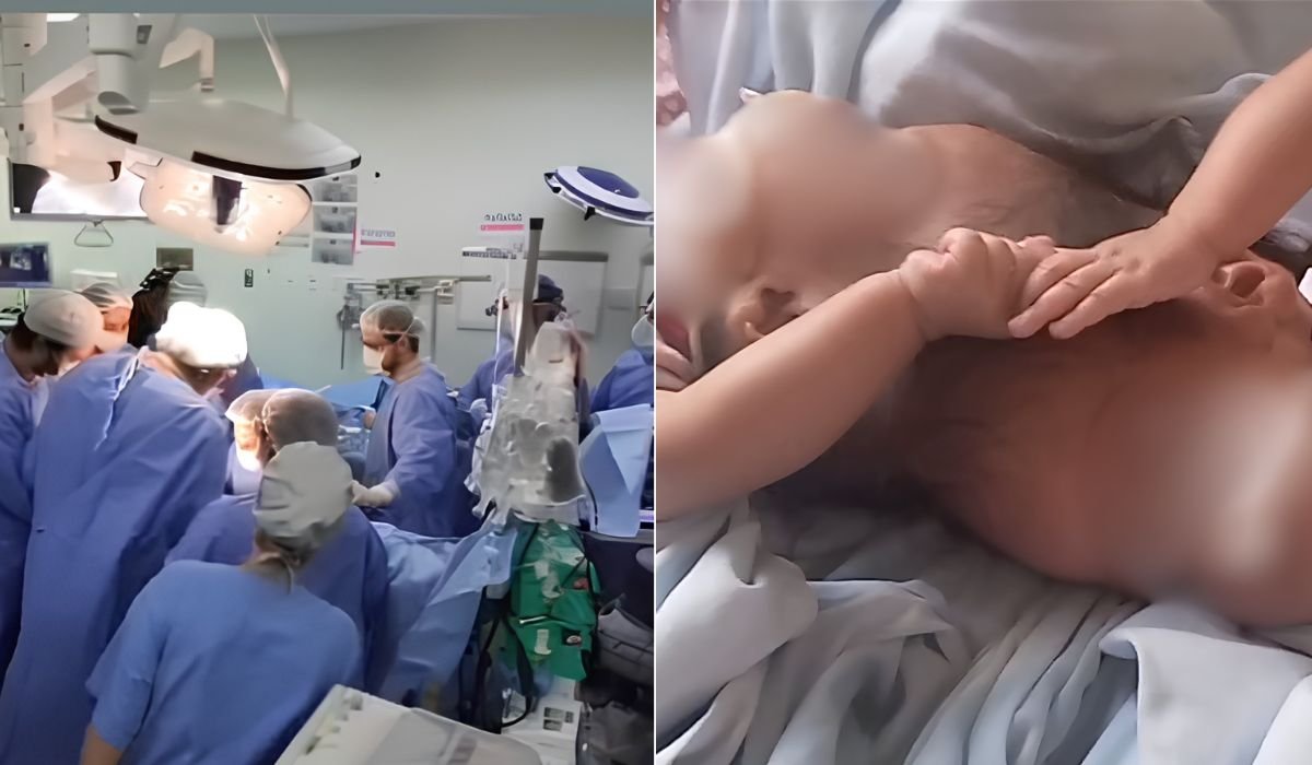 Após 15 horas de cirurgia, morrem gêmeas siamesas que nasceram unidas pela cabeça